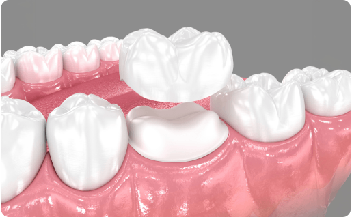 Dental filling