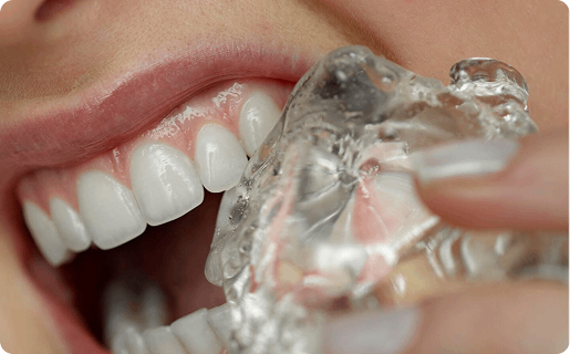 Chipped tooth