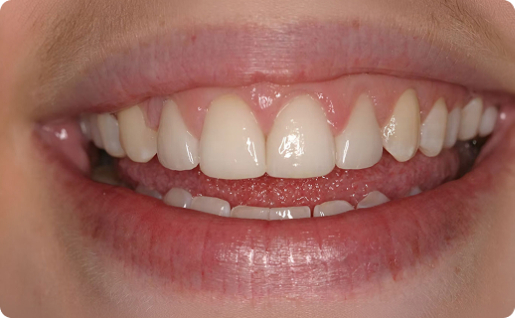 Picture of teeth woman